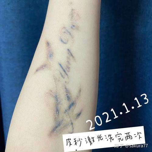 洗纹身后的图片,重拾自信的美丽瞬间